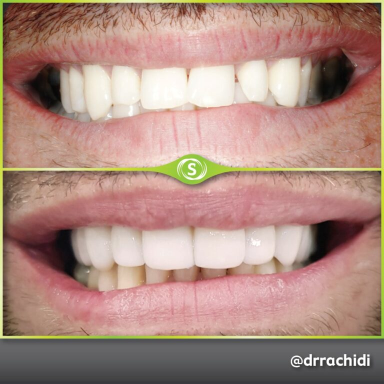 Dental Crowns E-max Zirconia - Dr. Karim Rachidi