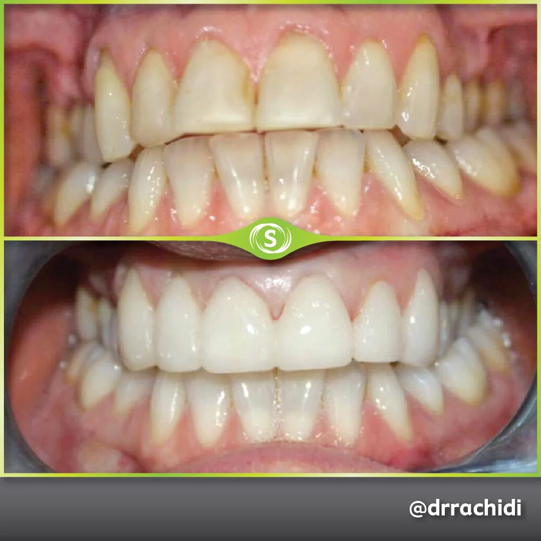 Dental Crowns Zirconia - Dr. Karim Rachidi