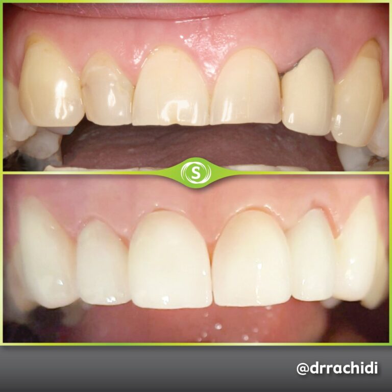 Dental Veneers - Dr. Karim Rachidi