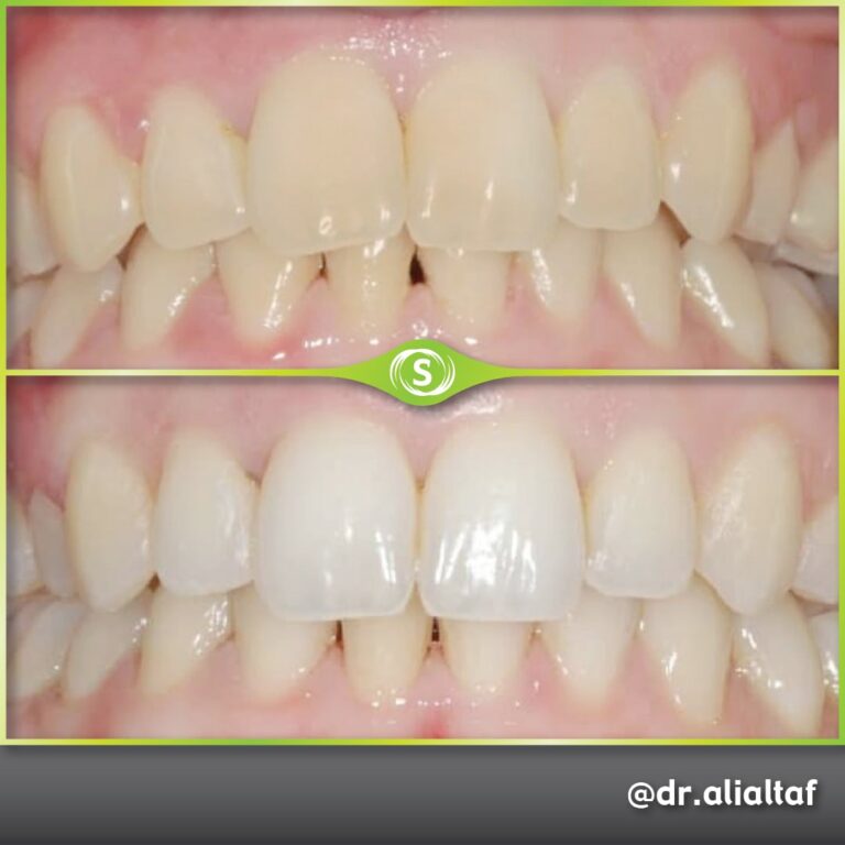 Invisalign and Teeth Whitening - Dr. Ali Altaf