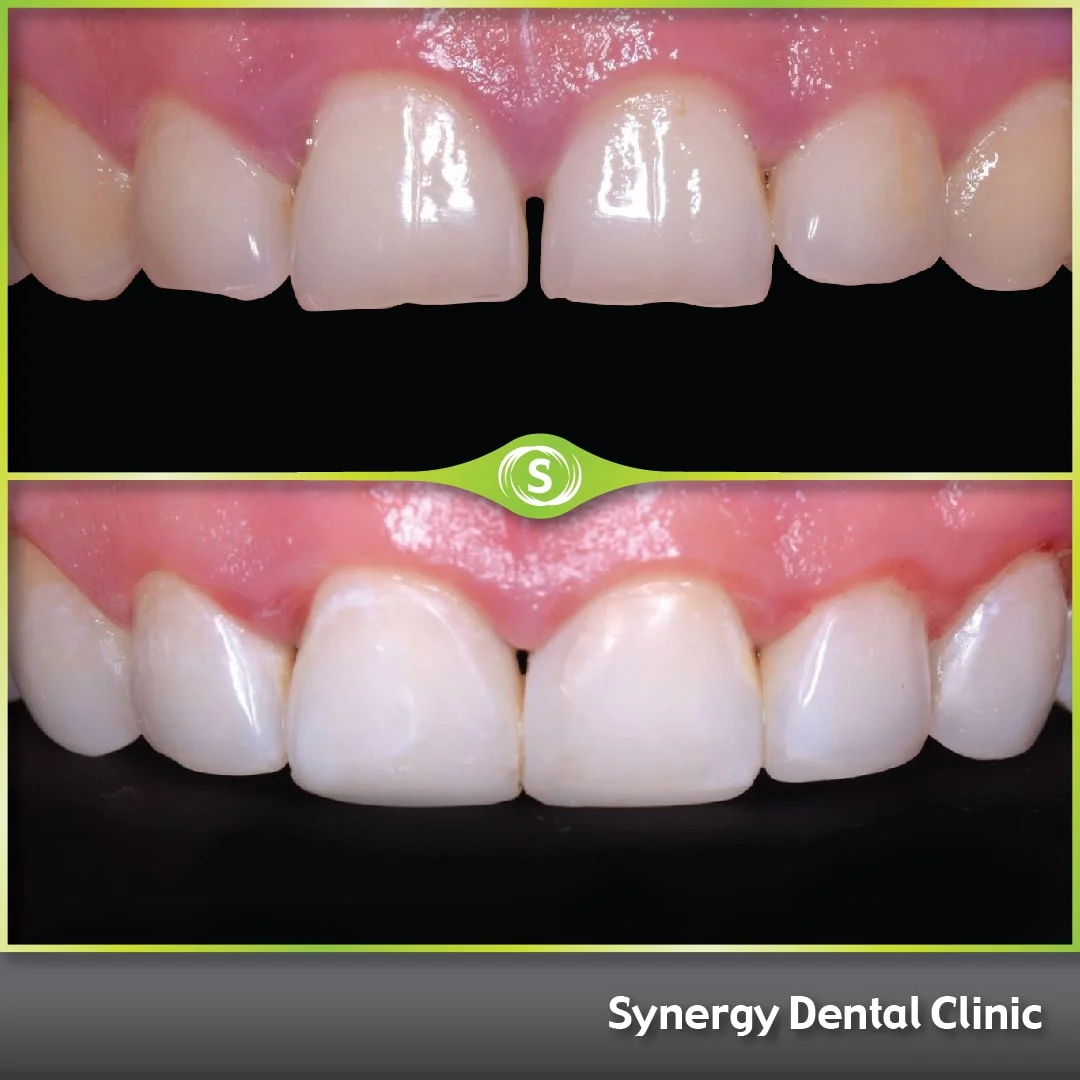 Composite Bonding Case 441