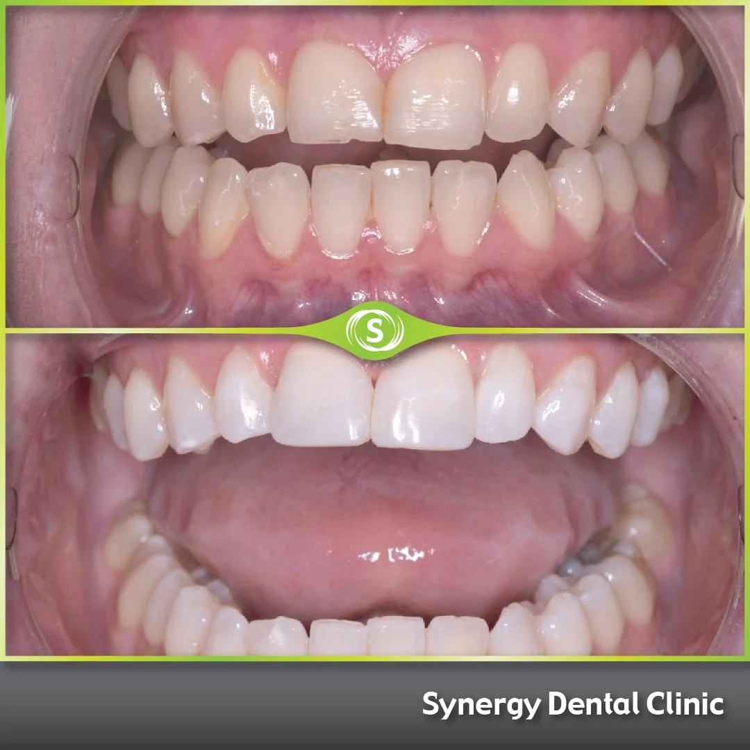 Composite Bonding Case 442
