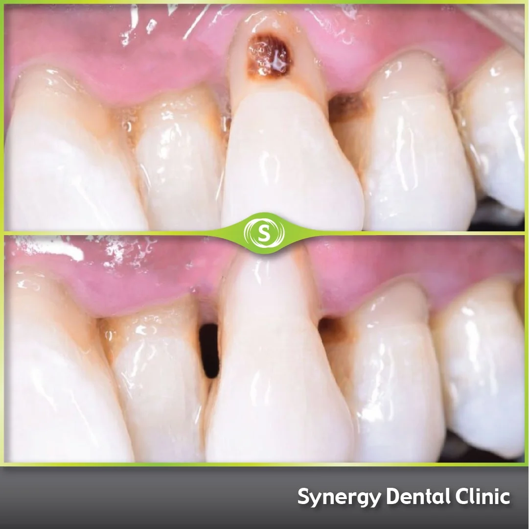 Composite Bonding Case 443