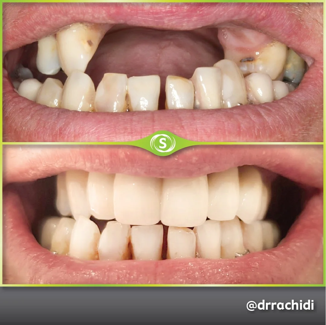 B&A Implant KR 1-min