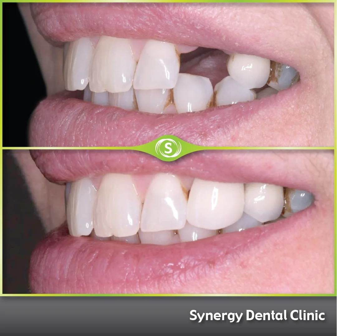 B&A Single Dental Implant SDC