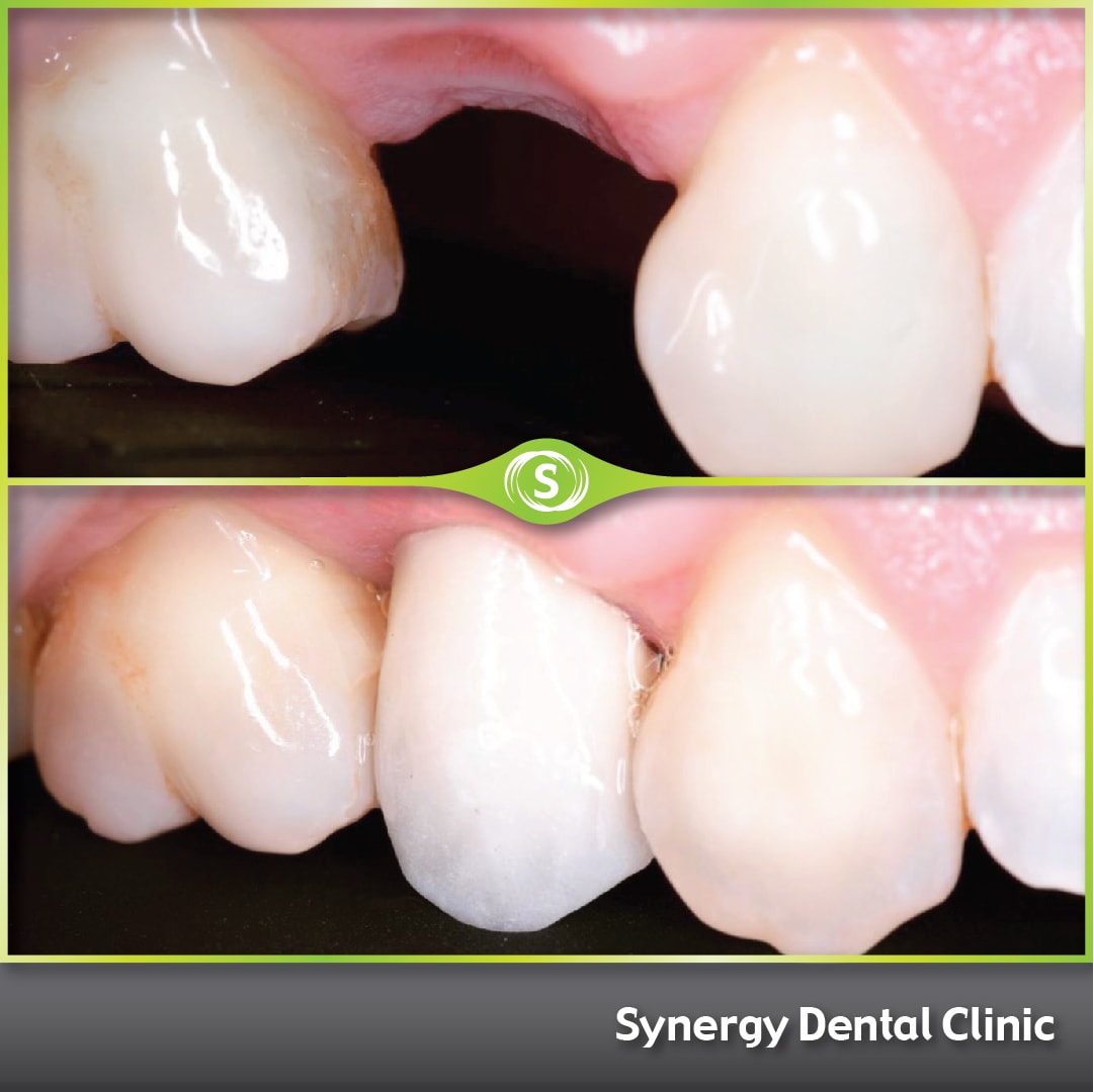 B&A Single Dental Implant SDC 258
