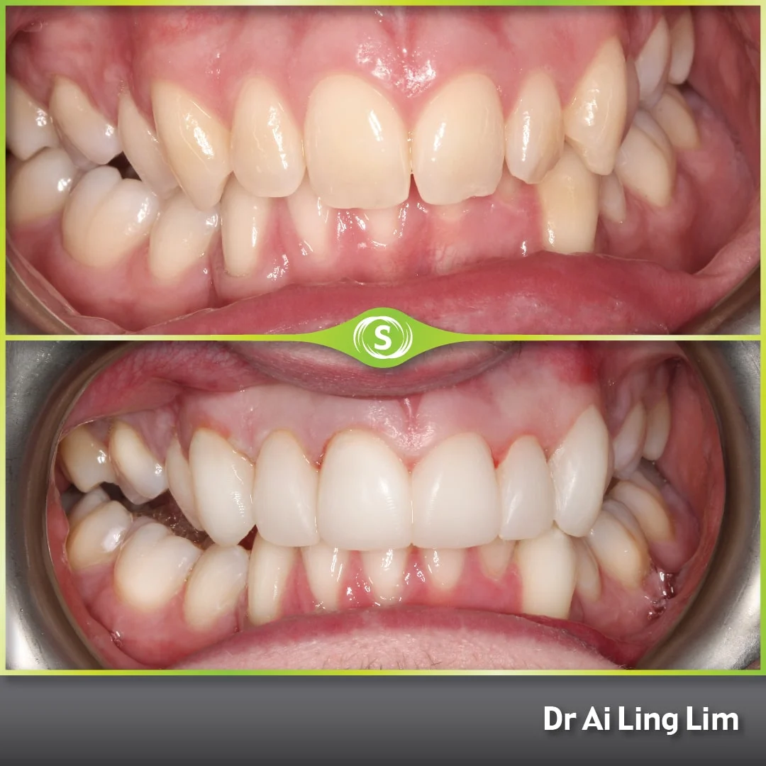 B&A Comp Bond AL 1-min (1)