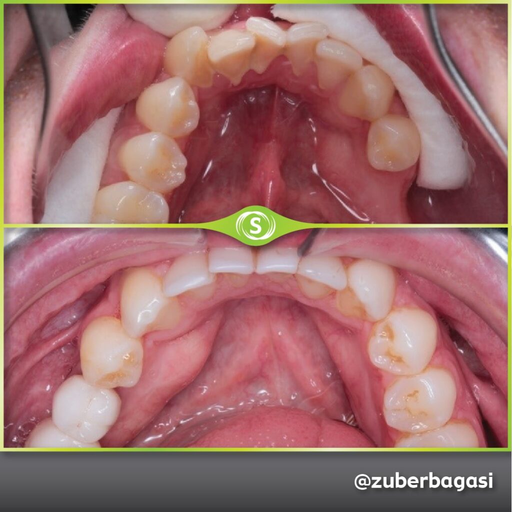 Dental Case Study Implants - Dr. Zuber Bagasi