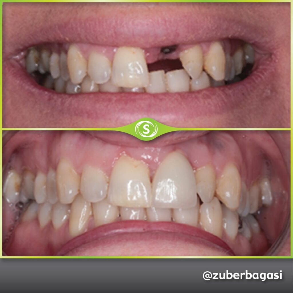 Dental Implant Case - Dr. Zuber Bagasi