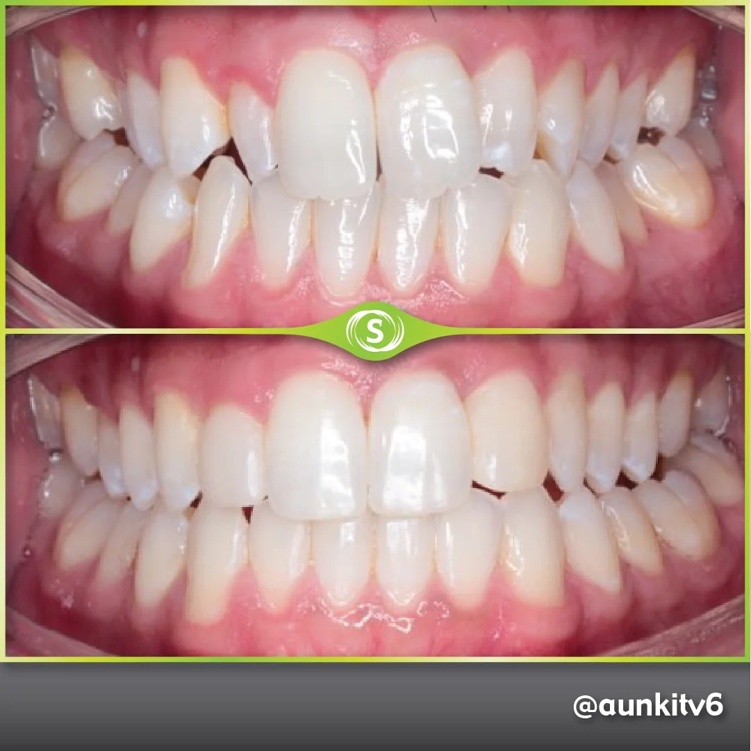 B&A Invisalign AV 4a-min