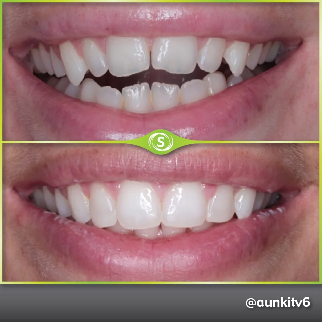 B&A Invisalign AV 6-min (1)