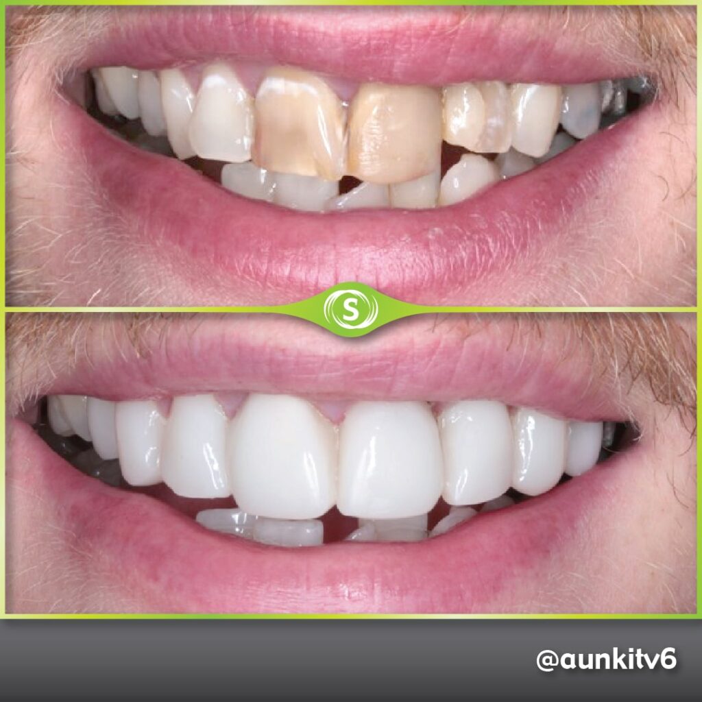 Before and After Composite Bonding Cases • Synergy Dental Clinics