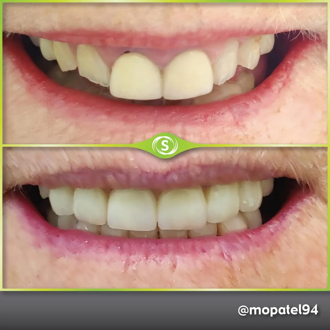 B&A Zirconia Crowns MP 1-min (1)