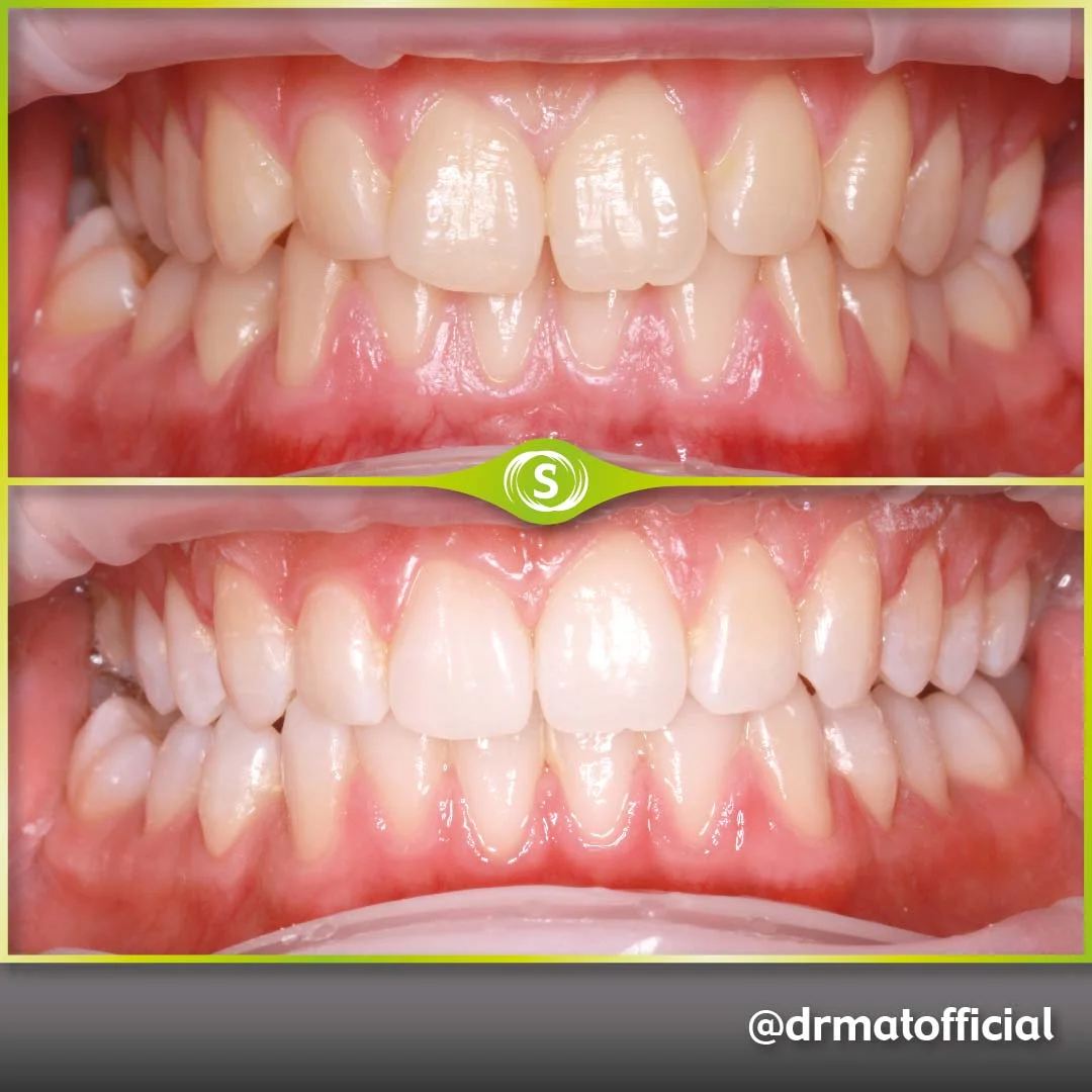 Invisalign and Composite bonding