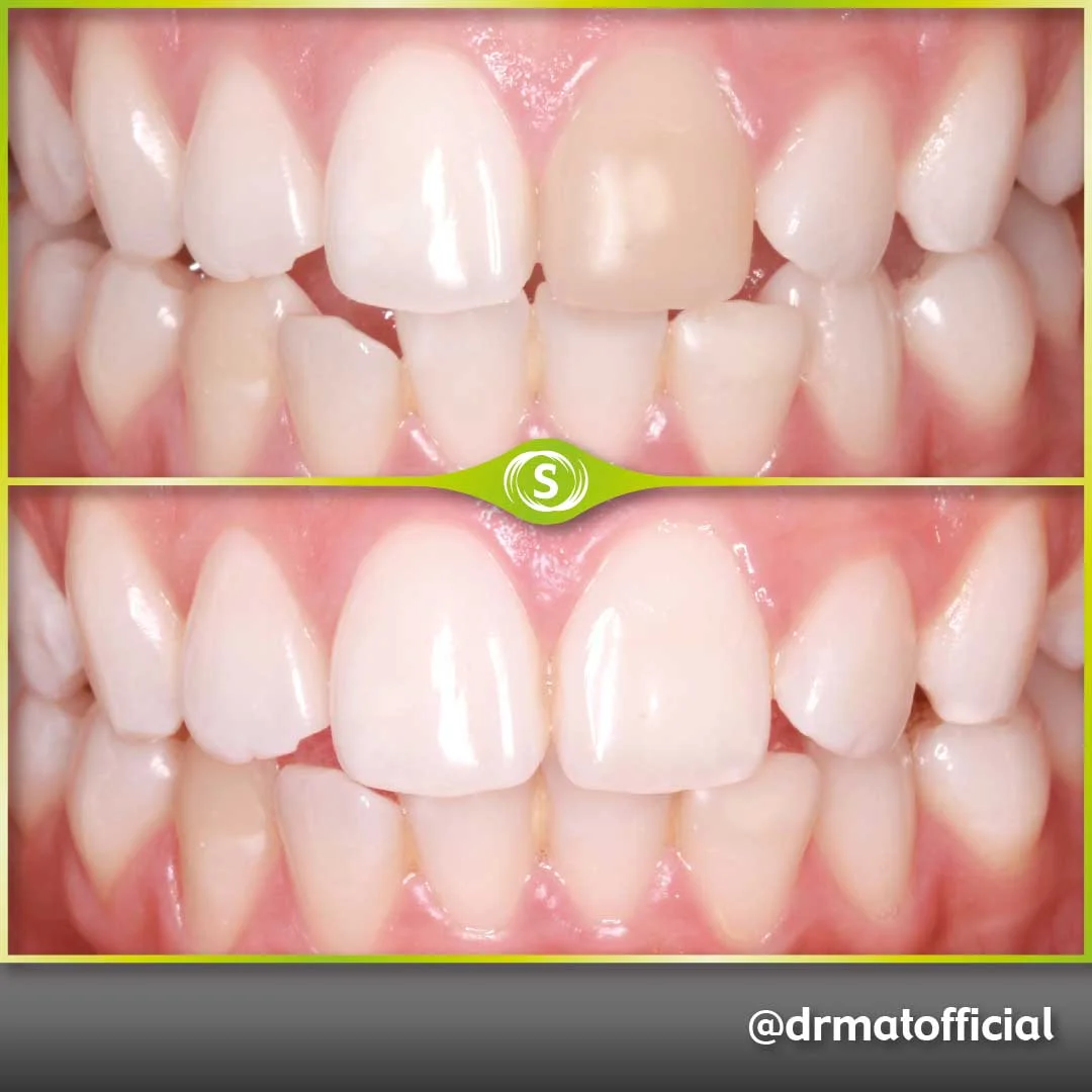 Composite bonding