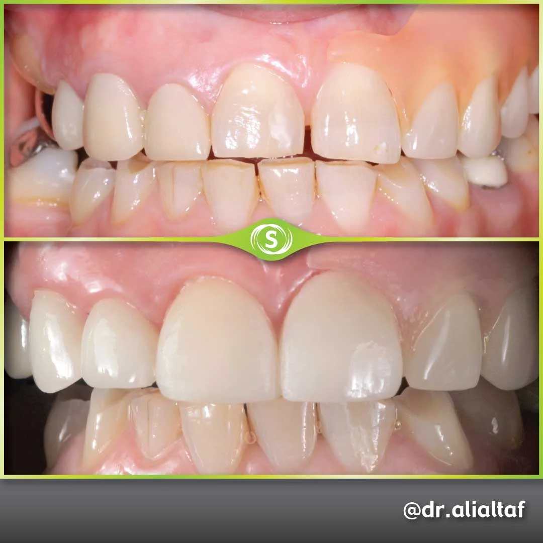 Emax Veneers