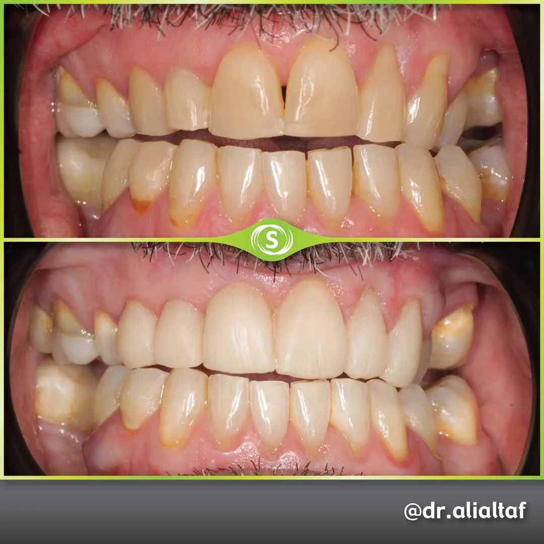 Composite bonding