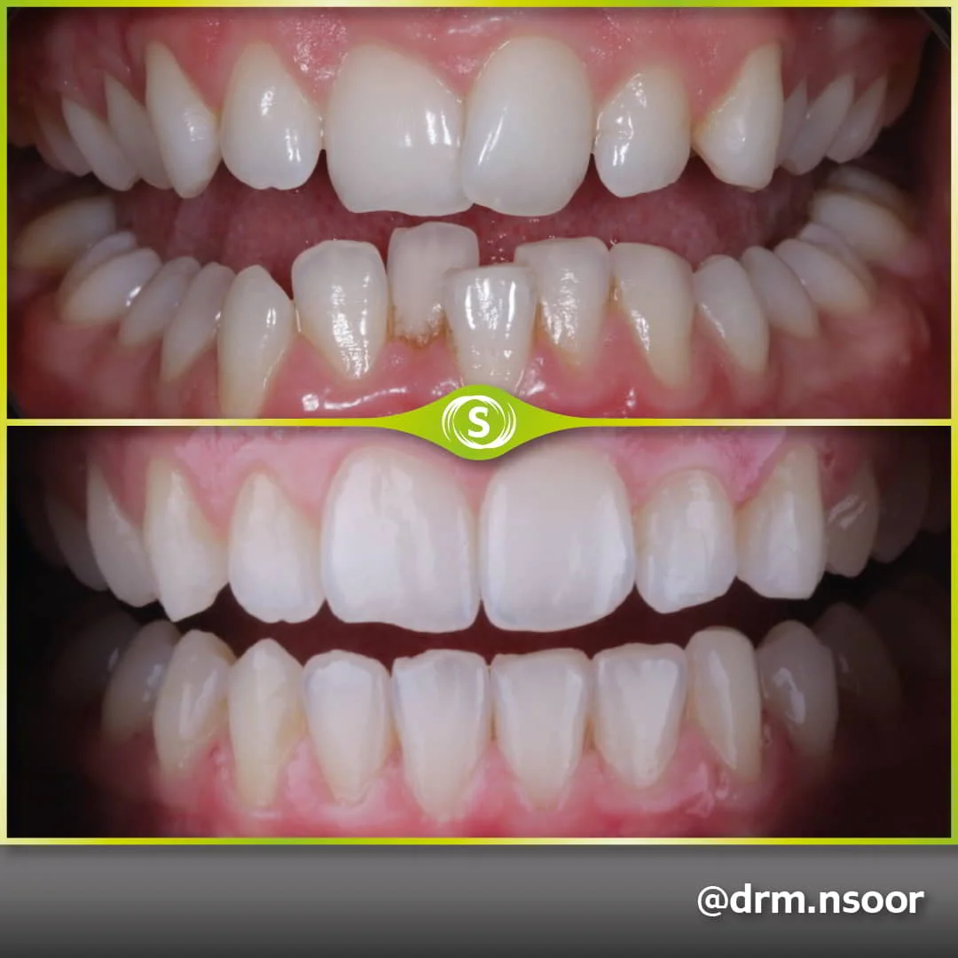 Before and After Invisalign and Teeth Whitening