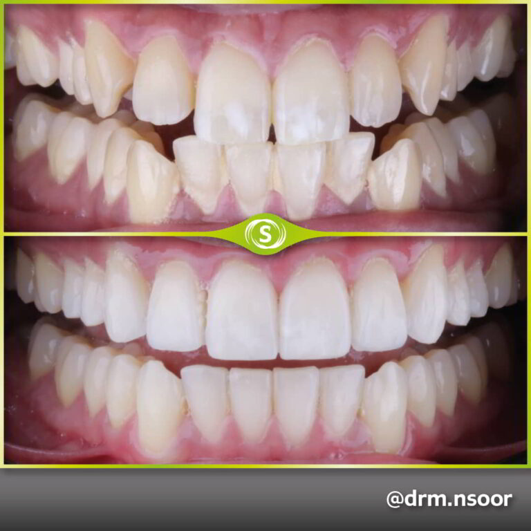 Before and After Invisalign and Composite Bonding Case 3437 Dr. Mansoor Patel