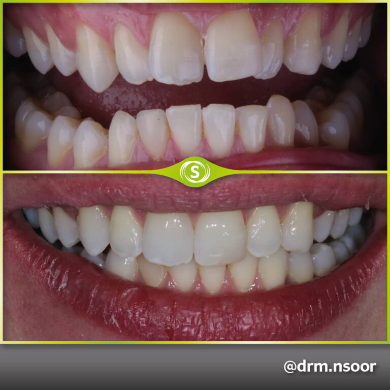 Before and After Invisalign And Bonding Case 7765 Dr. Mansoor Patel