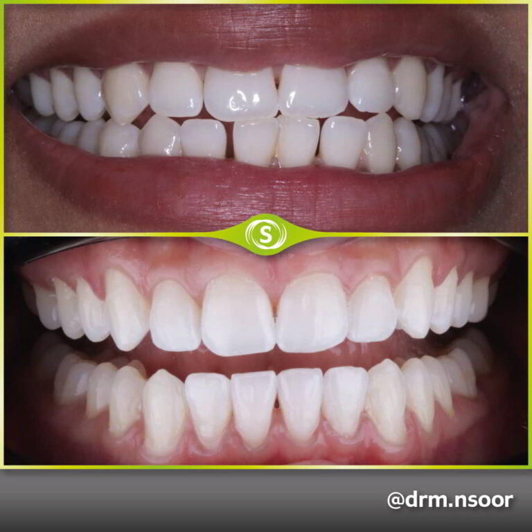 Before and After Teeth Straightening Invisalign and Composite bonding Dr. Mansoor Patel