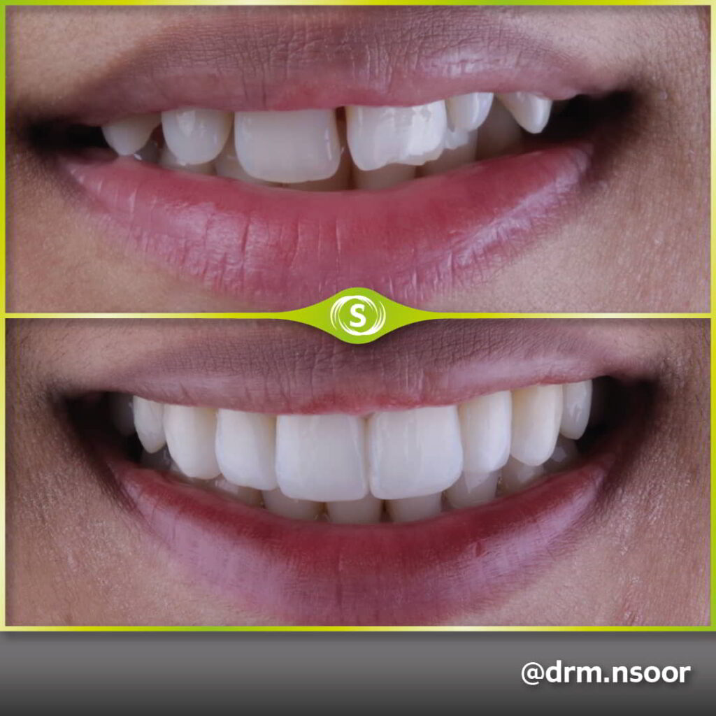 Before and After Invisalign and Composite bonding Case 4563 Dr. Mansoor Patel