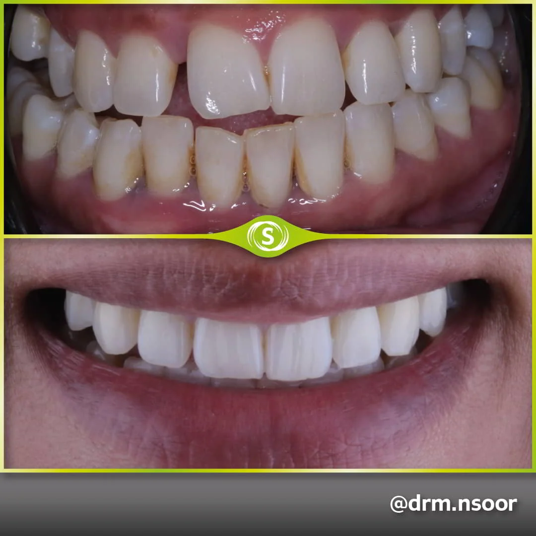 Before and after Invisalign Dr. Mansoor Patel