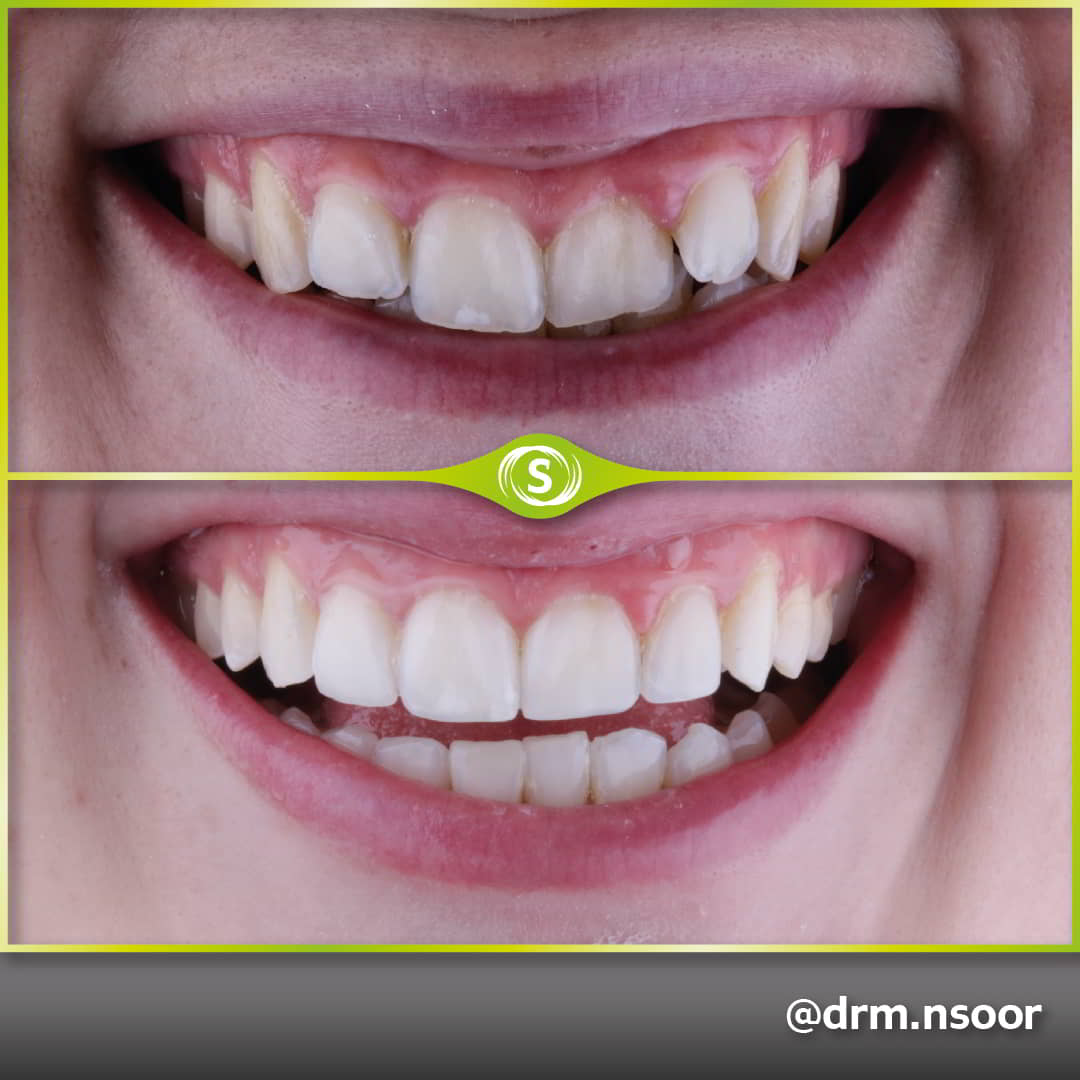Before and after invisalign and composite bonding - Dr. Mansoor Patel