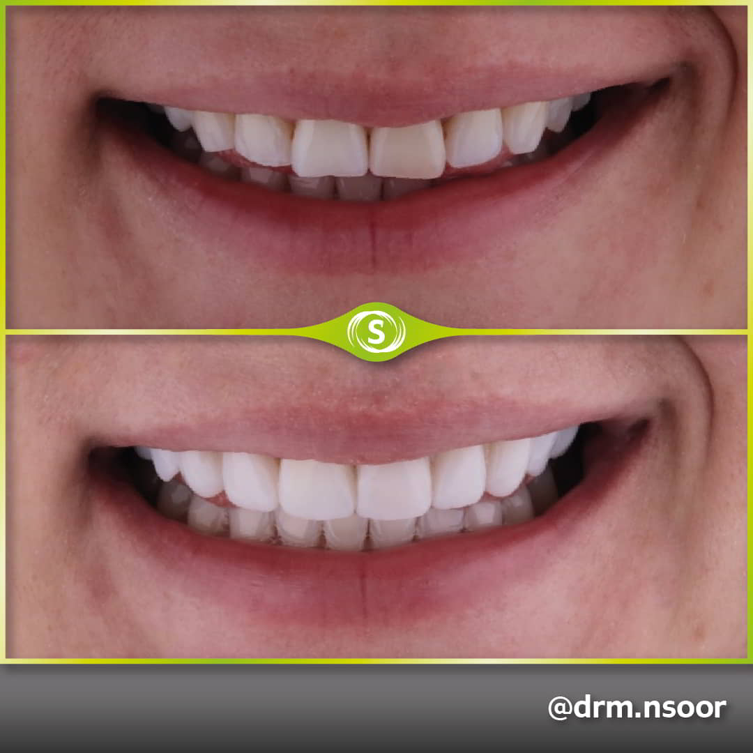 Before and After Composite bonding Case 8844 Dr. Mansoor Patel