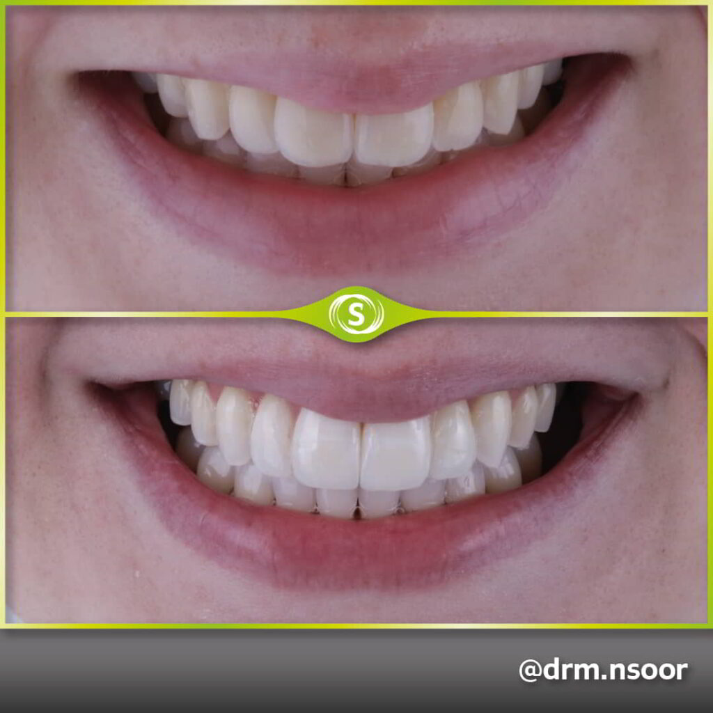 Before and After Composite Bonding Case 8759 Dr. Mansoor Patel