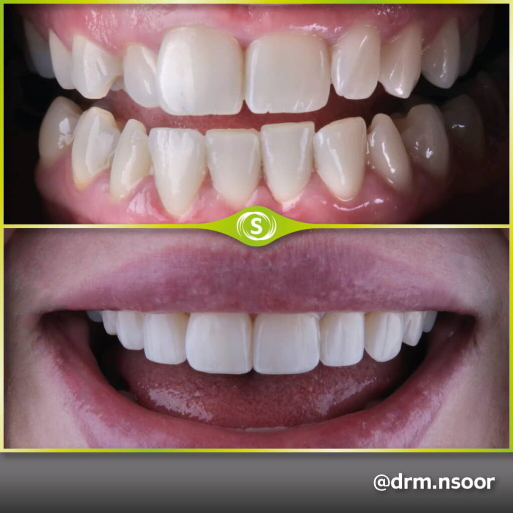 Before and After Teeth Straightening and Composite bonding case 4434 Dr. Mansoor Patel