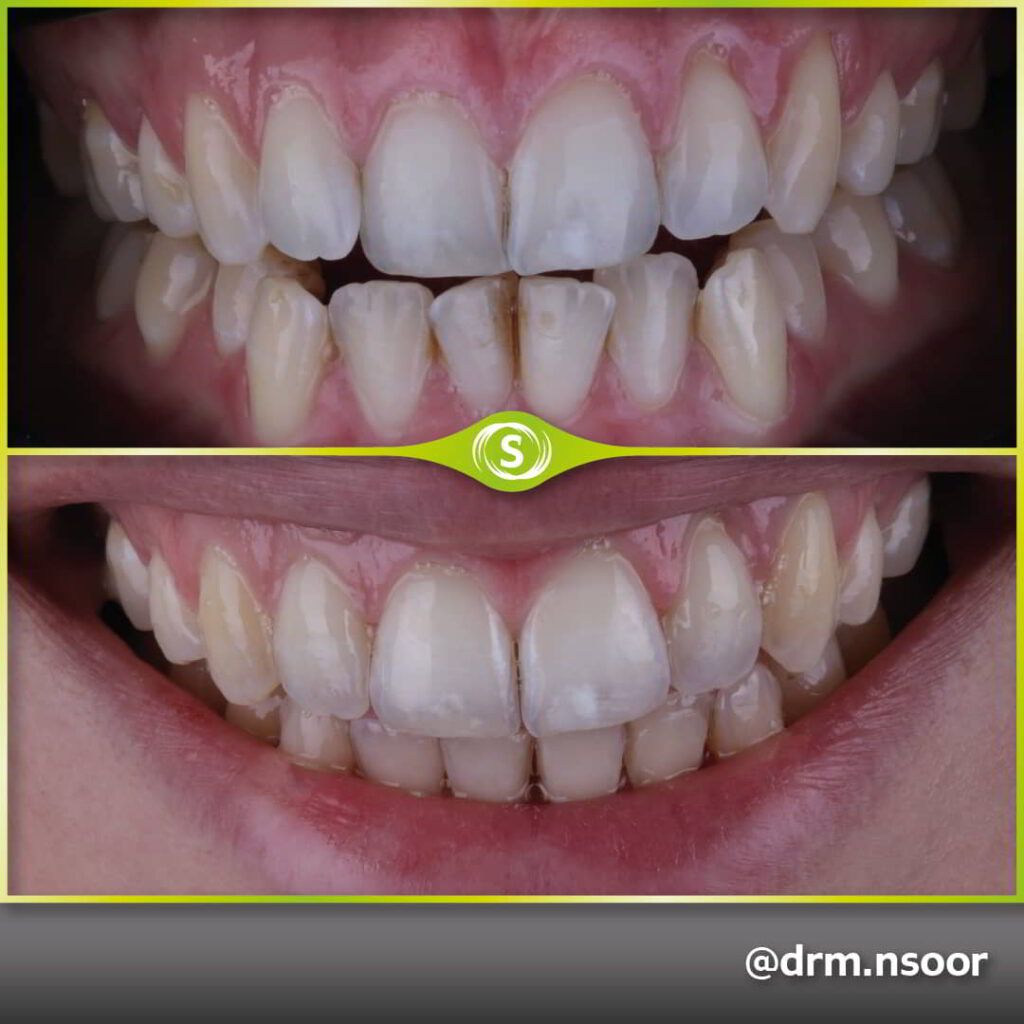Before and After Teeth Straightening and Composite Bonding Case 9874 Dr. Mansoor Patel