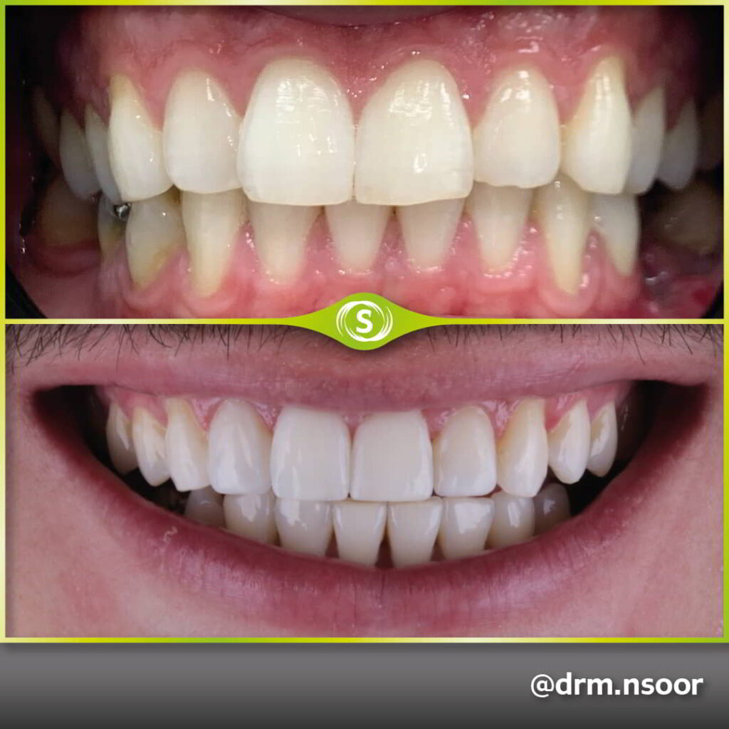 Before and After Invisalign and Composite Bonding Case 6645 Dr. Mansoor Patel