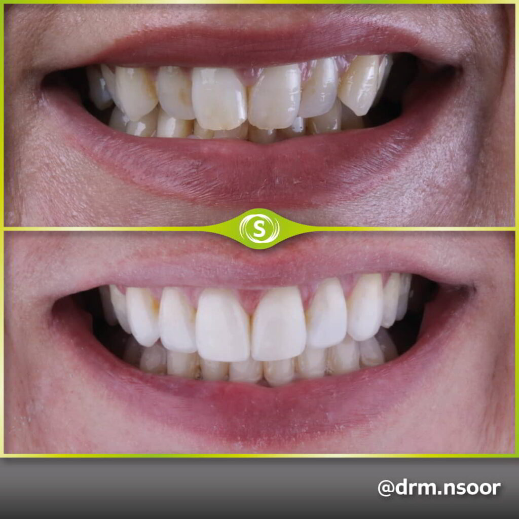 Before and After Invisalign and Composite Bonding Case 9978 Dr. Mansoor Patel