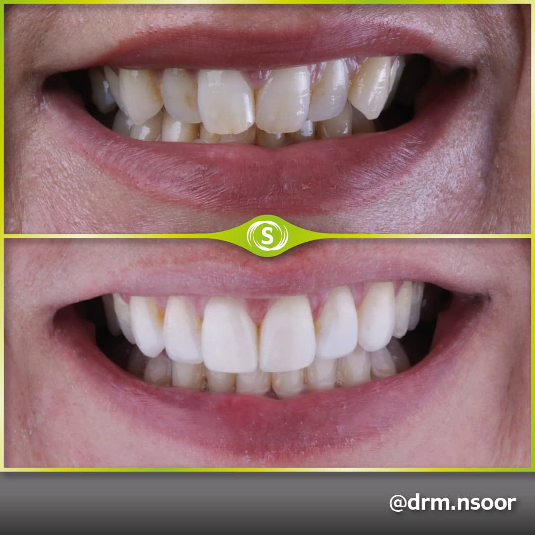 Before and After Invisalign and Composite Bonding Case 9978 Dr. Mansoor Patel