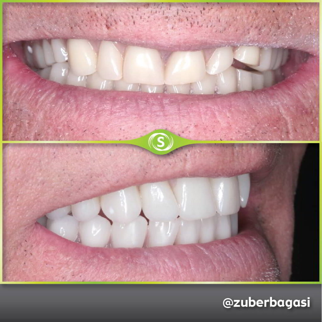 Before and after suction dentures