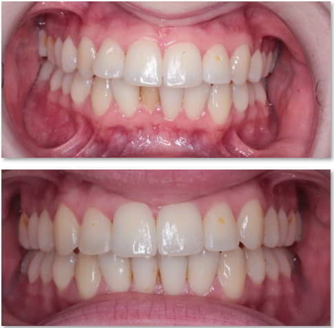 Case study teeth straightening Dr. Zuber Bagasi