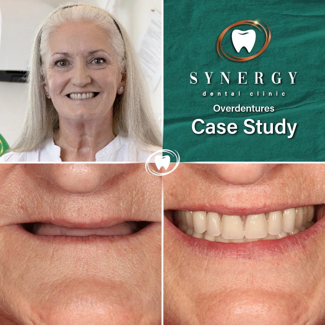 Before and After Case Study Overdentures - OD 1 SC