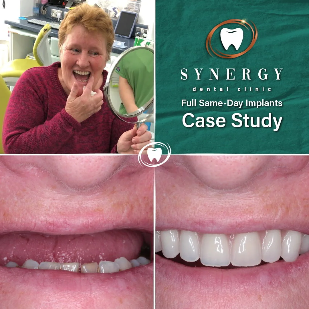 Before and After Case Study Same day implants