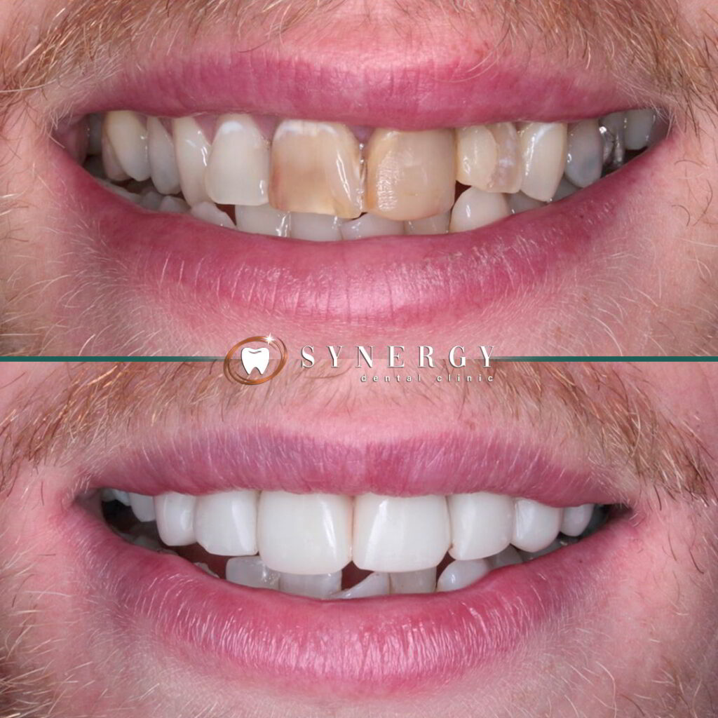 Dr. Aunkit Vaja Synergy Blackpool Composite bonding • Synergy