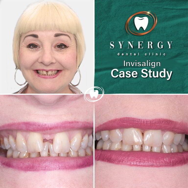Dr. Zuber Bagasi - Synergy Blackpool - Invisalign
