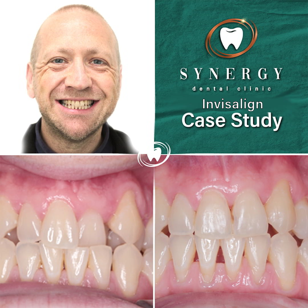 Dr. Zuber Bagasi - Synergy Blackpool - Invisalign complex