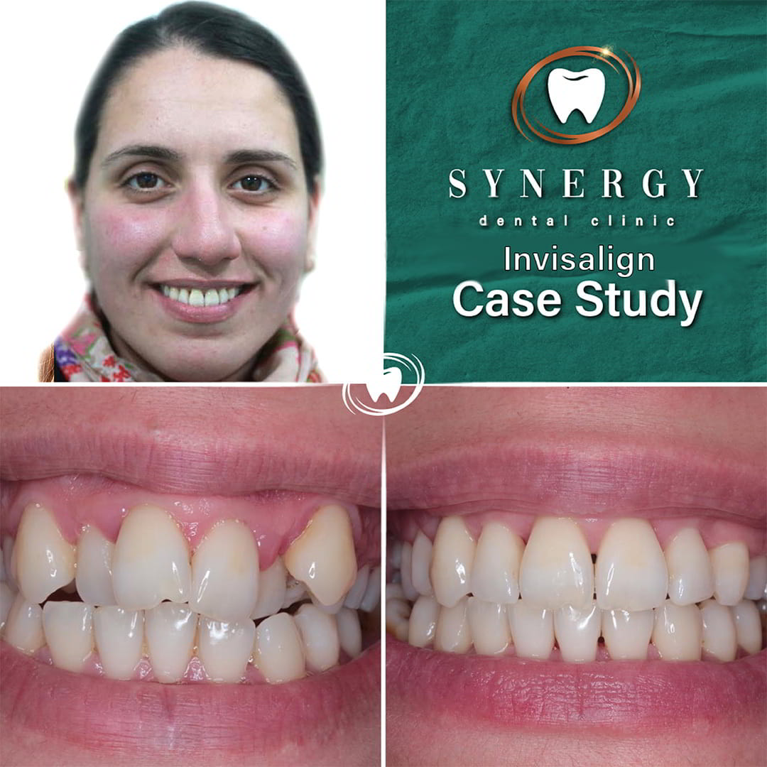 Dr. Zuber Bagasi - Synergy Blackpool - Invisalign