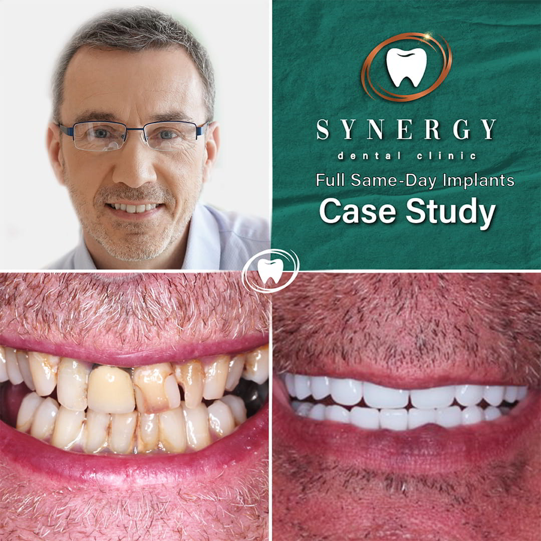 Dr. Zuber Bagasi - Synergy Blackpool - Same day implants