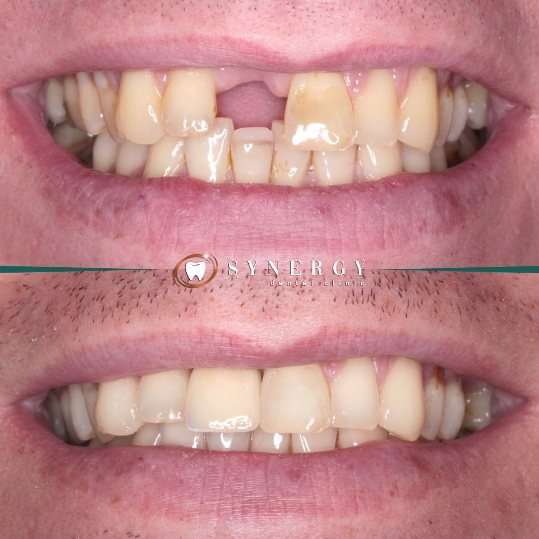Dr. Zuber Bagasi - Synergy Blackpool - Single implant