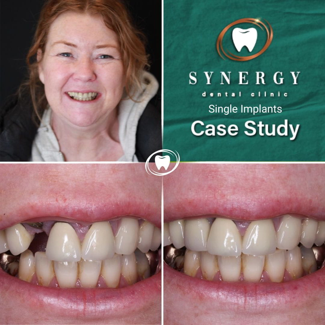 Dr. Zuber Bagasi - Synergy Blackpool - Single implant