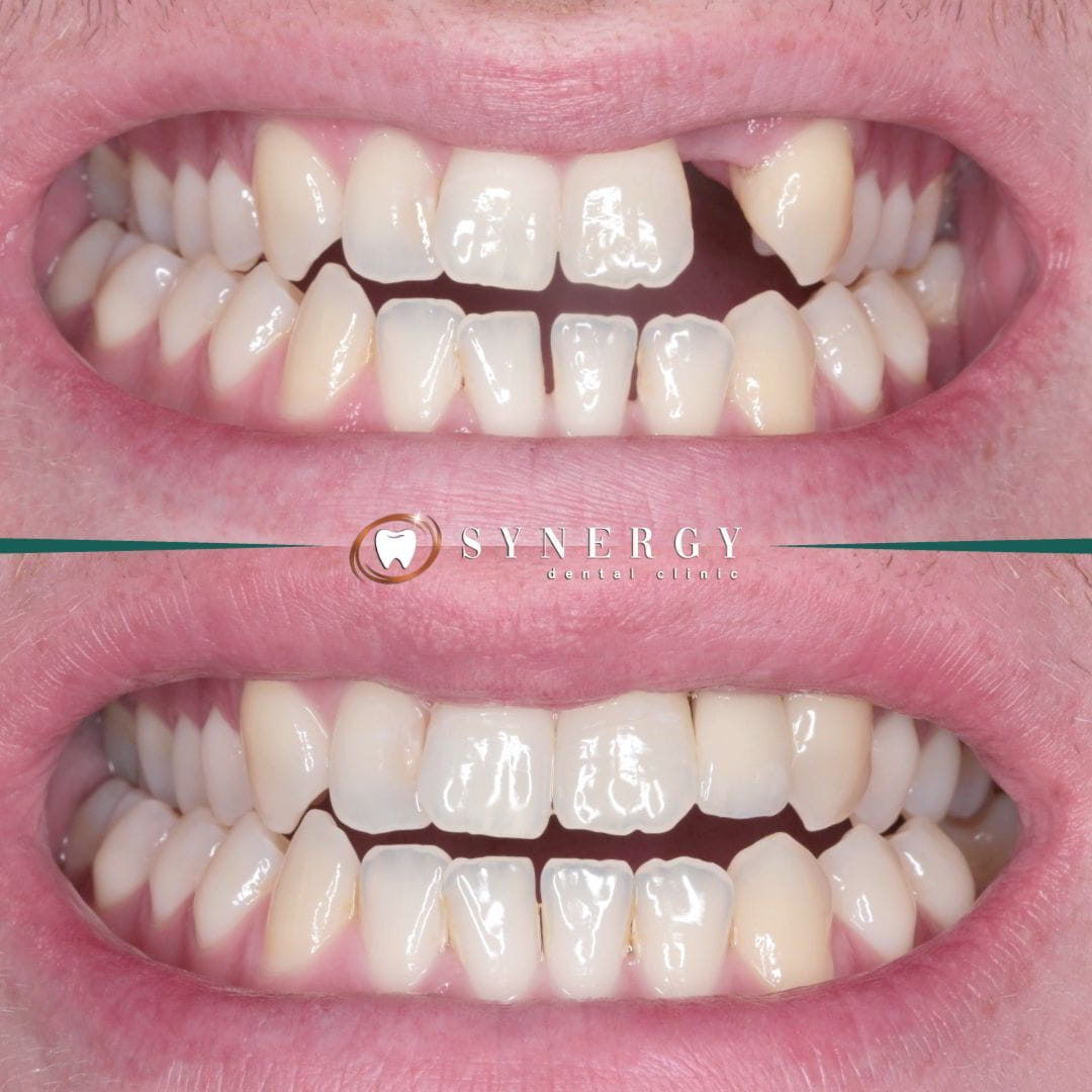 Dr. Zuber Bagasi - Synergy Blackpool - Single implant 7