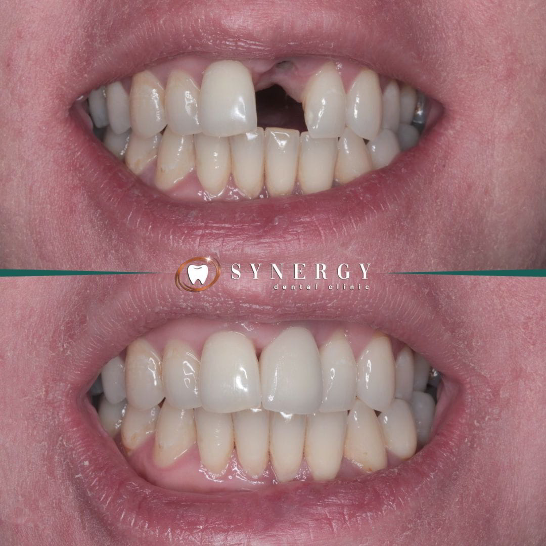 Dr. Zuber Bagasi - Synergy Blackpool - Single implant 9