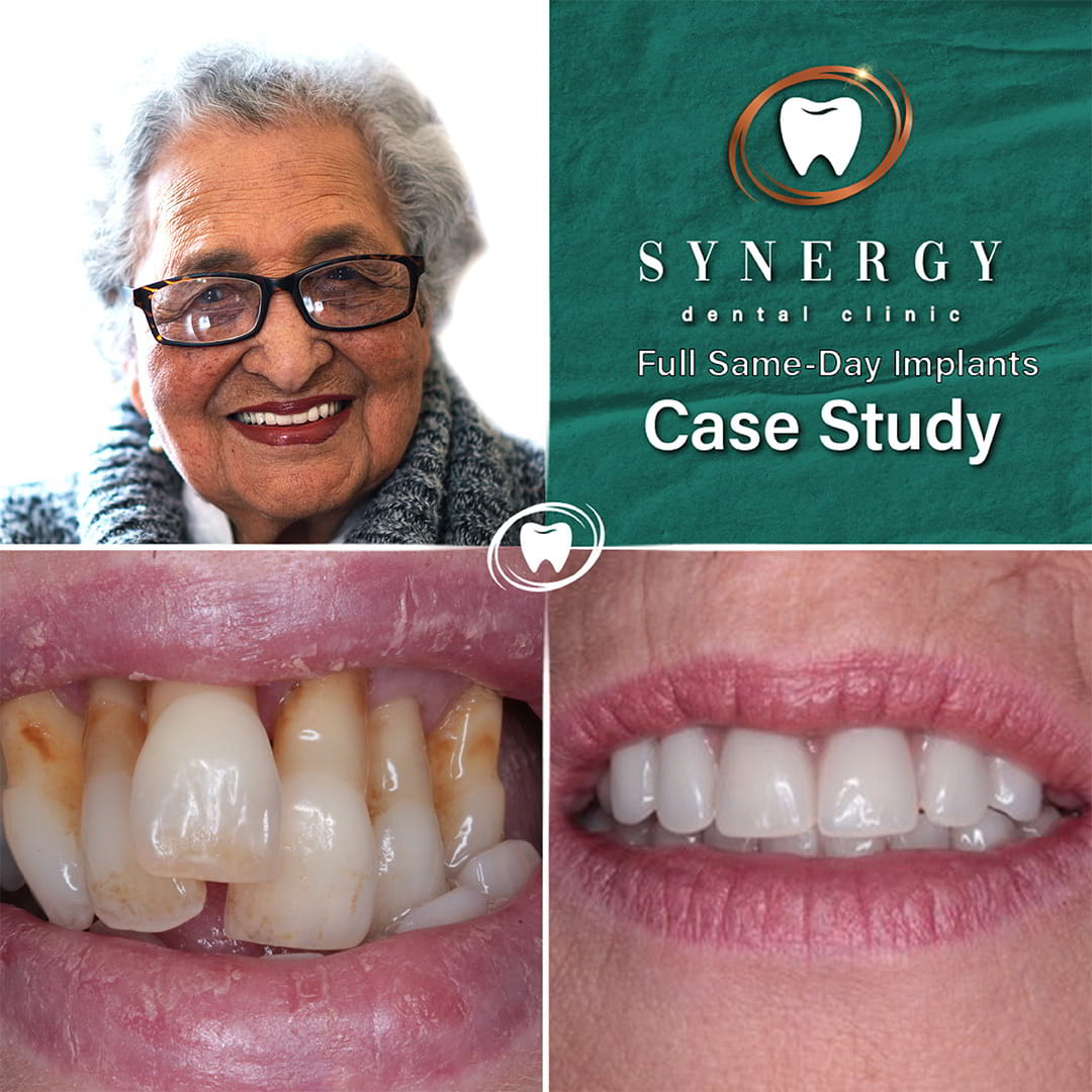 Dr. Zuber Bagasi - Synergy Dental - Same day implants