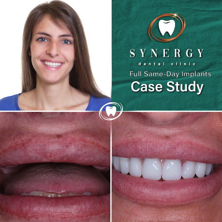 Dr. Zuber Bagasi - Synergy Dental - Same day implants